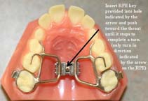 Rapid Palatal Expander